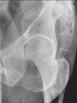 <p>PA axial OBL (acetabulum)</p>