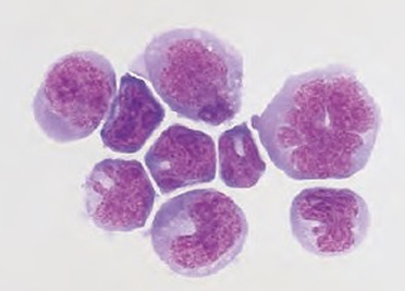 <p><strong><u>Predominant Cells in CSF</u></strong></p><ul><li><p>found in <span style="color: red;">disseminated lymphoma</span></p></li><li><p><span style="color: yellow;">resemble lymphocytes</span> with <span style="color: yellow;">cleft nuclei</span></p></li></ul><p></p>