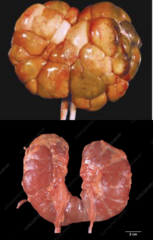 <p>Which renal developmental anomaly is being shown grossly?</p>