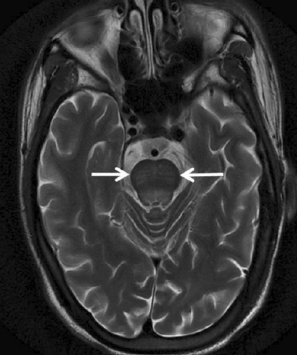 <p>cerebral pontine myelinolysis (CPM) or osmotic demyelination syndrome (ODS)</p>