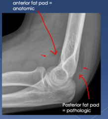 <p>- limited ROM</p><p>- pain with pronation and supination</p><p>- posterior fat pad (occult fx)</p>