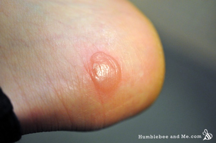 <p>from acute, short-term trauma</p><ul><li><p>fluid filled pocket that separates epidermal and dermal layers</p></li></ul><p></p>