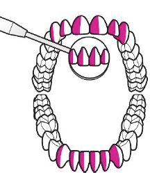 <ul><li><p>Tooth in purple are anterior surfaces (Away from clinician) </p></li><li><p><strong>Clinician sit: </strong>Clock position for anterior surfaces is 11 to 1 o’clock</p></li></ul><p></p>