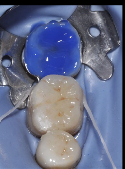 <p>37% phosphoric acid </p><ul><li><p>enamel: 30 sec </p></li><li><p>dentin: 15 sec </p></li></ul><p></p>