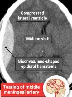 <p>epidural hematoma</p>