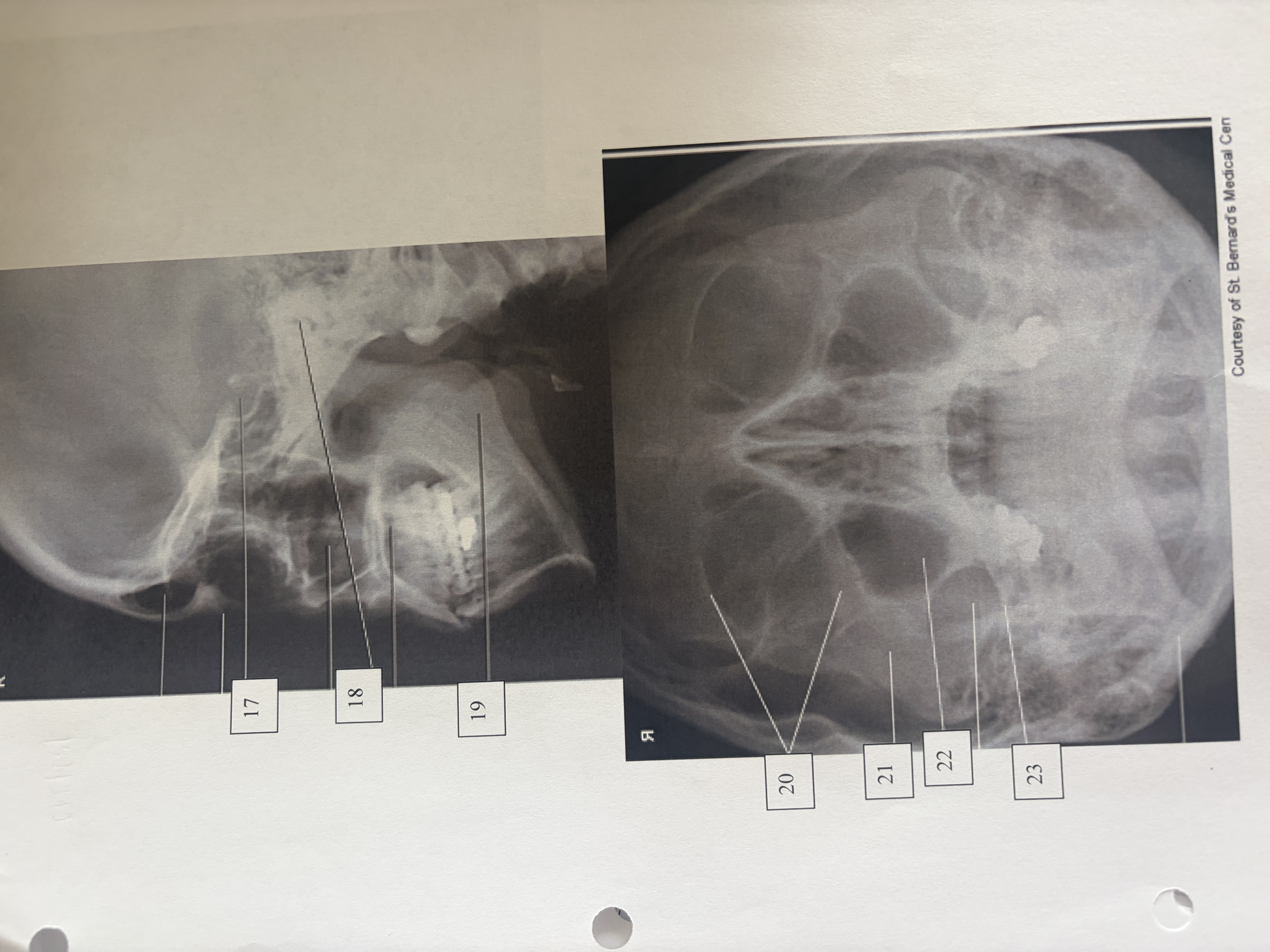 <p>maxillary sinus </p>