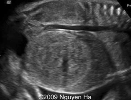 <ul><li><p>tumors of the fetal kidneys are rare</p></li><li><p><span style="color: red;">MC</span> fetal renal tumor is <span style="color: red;">mesoblastic nephroma (hamartoma)</span></p><ul><li><p>benign tumor</p></li><li><p>composed of oddly arranged indigenous tissue</p></li></ul></li><li><p><span style="color: red;">Wilms’ tumor</span> is malignant <span style="color: red;">renal </span>tumor; MC in females</p></li><li><p><span style="color: red;">neuroblastoma</span> is a malignant <span style="color: red;">adrenal</span> tumor</p></li></ul><p></p>