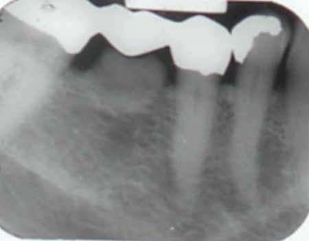 <p>cause of this lesion?</p>