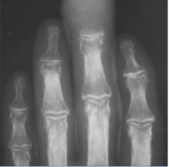 <p>What is this?</p><p>- MC malignant tumor of skeleton</p><p>- > 40 yo male</p><p>- Pain (Worse at night, Intractable)</p><p>- Found in Axial skeleton, Pelvis, Skull, Ribs/ Sternum, Proximal Long bones</p><p>- X-ray: 30-50% bone loss </p><p>- Bone Scan: Tech-99</p><p>- MRI: Gadolinium</p>