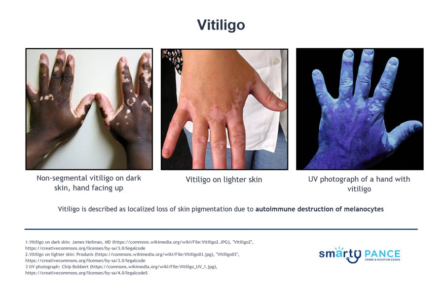 <p>Autoimmune condition in which the body destroys its own melanocytes, leaving depigmented patches of skin and hair </p><p>-Presentation: well-demarcated chalk-white patches with normal or hyperpigmented borders. Common on the face, hands, wrists, axillae and genitalia </p><p>-Common in Hashimoto thyroiditis, Graves disease, T1DM, Addison disease, alopecia areata </p><p>-Dx: Wood lamp</p><p>-Tx: sun protection, topical corticosteroids, Ruxolitinib cream </p>