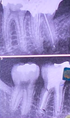 <p><strong>packing of:</strong></p><ul><li><p>dentin chips</p></li><li><p>paper points  </p></li><li><p>tissue debris</p></li><li><p>cotton pellets</p></li><li><p>restorative materials</p></li><li><p>fractured instrument in the canal</p></li></ul><p></p>