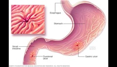 <p>Ulcers in stomach from NSAIDs, stress, H. pylori.</p>