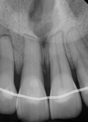 <ol start="79"><li><p>Identify the finding shown.</p></li></ol><p></p>