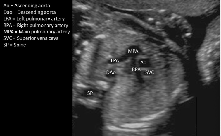 <p>Ascending aorta</p>
