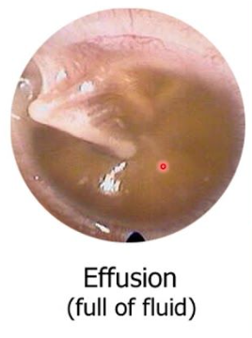 <ul><li><p><span>Accumulation of serous fluid in the middle ear without acute inflammation</span></p></li><li><p><span>Can precede or follow AOM, but barotrauma or chronic allergic rhinitis also can precipitate an occurrence</span></p></li><li><p><span>Chronic effusion is characterized by hearing impairment and may persist for several months, with or without signs of infection</span></p></li><li><p><span>Tympanic membrane may bulge or retract but should not be red. May see yellow or clear fluid with air bubbles.</span></p></li><li><p><span>Oral decongestant</span></p></li></ul><p></p>
