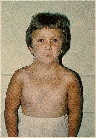 <p>excess skin - webbing of neck</p>