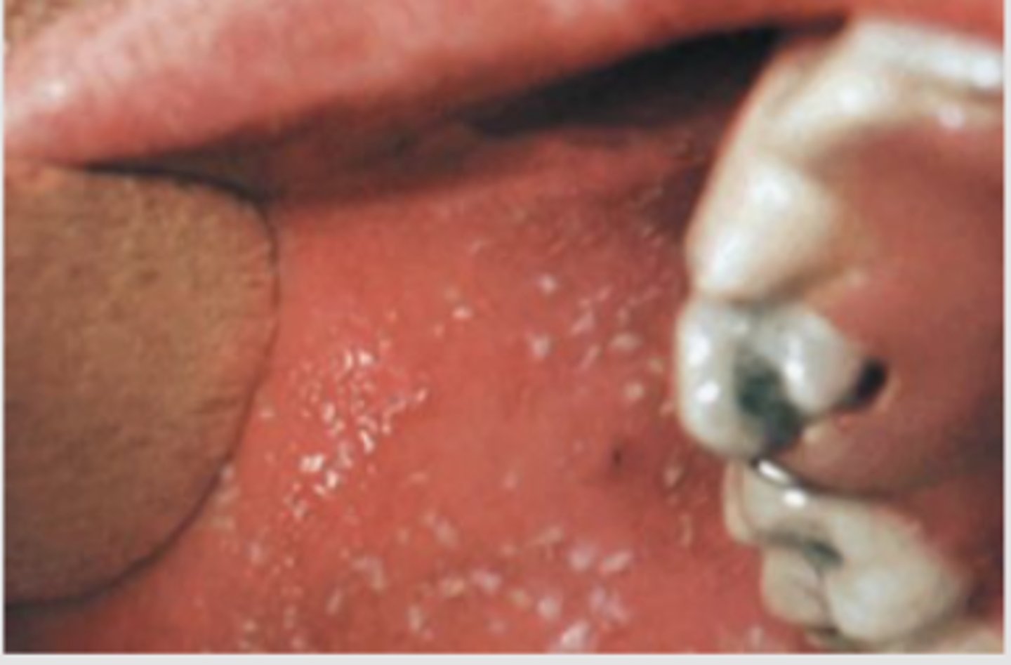 <p>Koplik spots are an early sign of measles (rubeola).&nbsp;</p><p>Search for small white specks that resemble grains of salt on a red background.&nbsp;</p><p>They usually appear on the buccal mucosa near the first and second molars.&nbsp;</p>