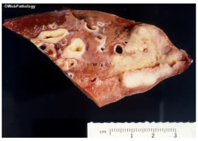 <p>Wedge resection</p>