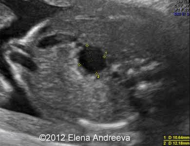 <p>cystic dilatation of the common bile duct.</p>