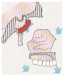 <ul><li><p>happens when bone position changed bc of growth of adjacent bone</p></li><li><p>eg cranial base grows, moving maxilla down and forward, second degree of maxilla displacement</p></li></ul><p></p>