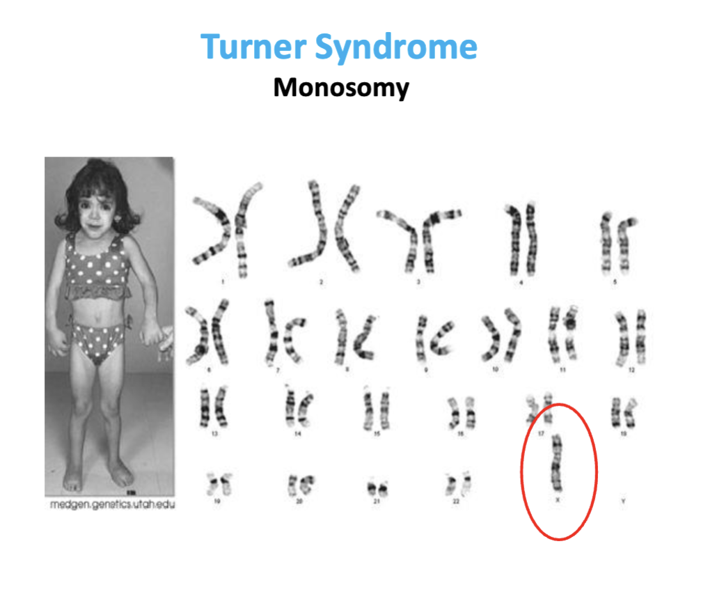 <ul><li><p>X chromosome monosomy</p></li><li><p>a genetic condition affecting only females. It occurs when one of the X chromosomes is completely or partially missing</p></li><li><p><span>Because embryos with a 45,Y chromosomal makeup are not viable early in development, Turner syndrome only occurs in individuals with a female chromosomal background.</span></p></li></ul><p></p>
