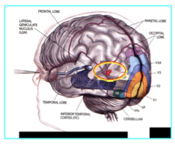<ul><li><p>Damage to area MT (middle temporal lobe) results in Akinetopsia </p></li></ul><p></p><ul><li><p><span>Lose ability to detect motion/movement</span></p></li></ul><ul><li><p><span>Incredibly rare cases, has to happen on both sides</span></p></li></ul><p> </p><p> </p><ul><li><p><span>Like living under a strobe light</span></p></li><li><p><span>One person here at one point of time, another at another point of time</span></p></li><li><p><span>Pouring coffee or tea, see motion when see level change, if don’t see motion, at one point in time its like oh my cup is empty, the next thing you know you spilled coffee or tea all over the table because you didn't detect that motion that led to that change.</span></p></li><li><p><span>Have to rely on this comparison of one point in time to another point in time</span></p></li></ul><p></p>