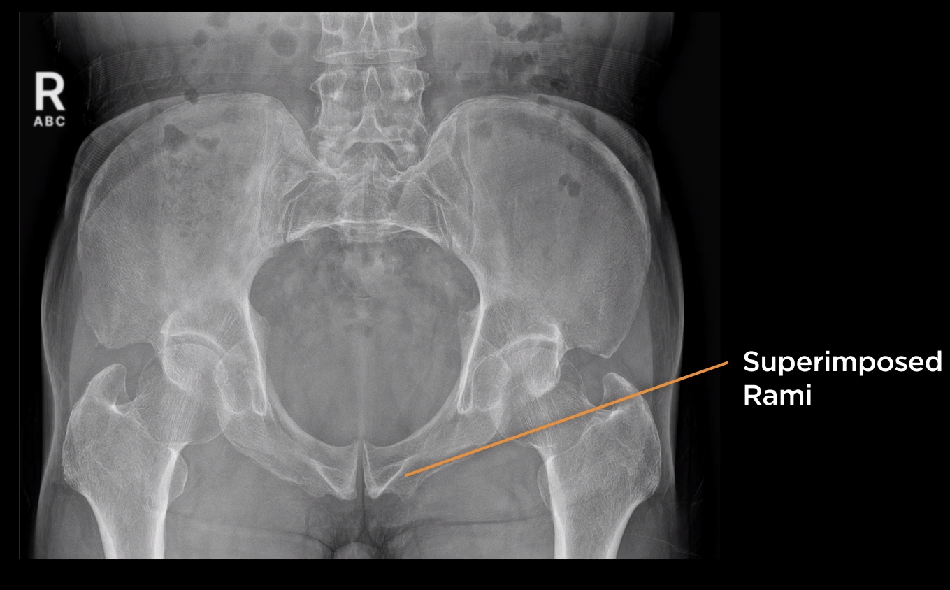 <p>AP Pelvis Inlet or Outlet?</p>