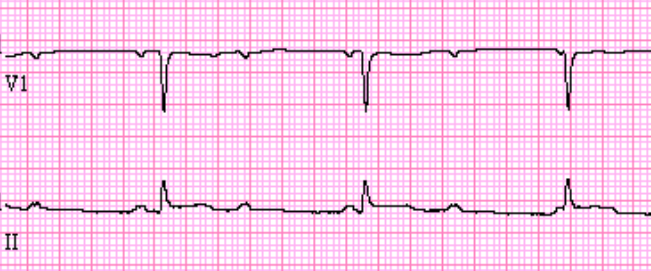 <p>Rate: depends on underlying rhythm</p><p>Regularity: irregular </p><p>P waves are either absent, in QRS, after QRS, or inverted before QRS</p>