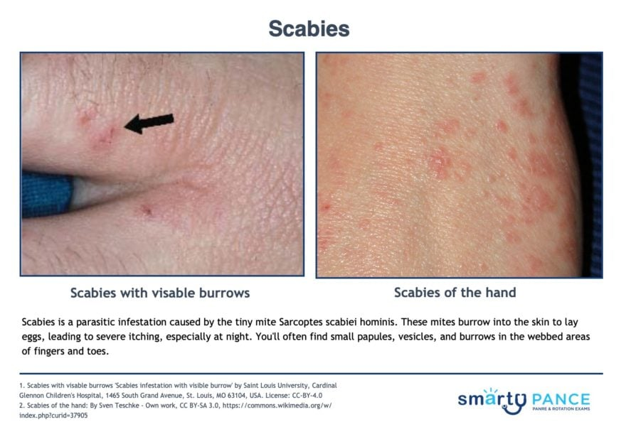 <p>Burrowing of Sarcoptes scabiei mites into the epidermis, which is spread by prolonged skin-to-skin contact</p><p>-Dx: clinical, skin scraping with mineral oil shows mites/eggs</p><p>-Presentation: intense itch especially at night, burrows especially in the finger webs and flexor wrists, and crusts </p><p>-Tx: permethrin 5% cream, repeat in one week </p>