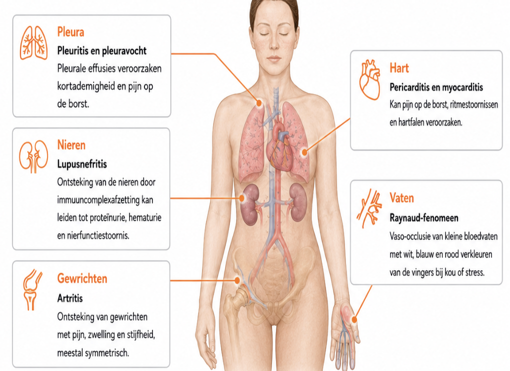 <ul><li><p>systemische auto-immuunziekte </p></li><li><p>gekarakteriseerd door genetisch doorbreken van de tolerantie voor meerdere auto-antigenen → waardoor antilichamen ontstaan, waaronder antiDNA</p><ul><li><p>het zijn vooral nucleaire antilichamen </p></li><li><p>al lang aanwezig voor diagnose </p></li></ul></li><li><p>er is vorming van immuuncomplexen → volledige complement activatie waardoor je niks van C in bloed ziet (alles in nieren verbruikt)</p><ul><li><p>full house</p></li></ul></li><li><p>vooral bij jongen vrouwen </p></li><li><p>nefritis is onderdeel ervan → maar ook hartklachten, gewrichtsklachten en vlinder exantheem </p></li></ul><p></p>