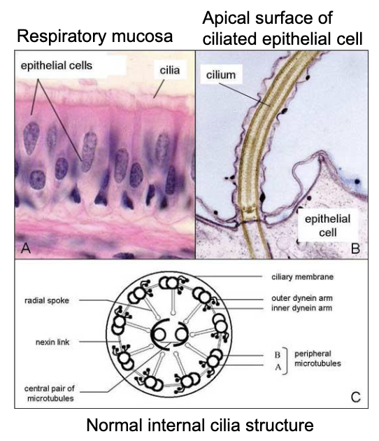 <p>Abnormal microtubules and/or loss of <strong>dynein arms</strong> cause defective motile cilia</p><ul><li><p>Can lead to abnormal respiratory mucosa, <strong>recurrent respiratory infections</strong>, digestive issues, and infertility</p></li></ul><p></p>