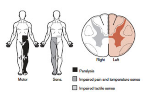 <p>Damage is on one side of spinal cord</p><p>Impairment or loss of movement and proprioception on injured side</p><p>Impairment of pain, temperature and touch sensation on opposite side</p>