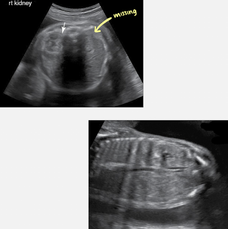 <ul><li><p>absent kidney on one side</p></li><li><p>contralateral kidney → compensatory hypertrophy</p></li><li><p><span style="color: red;">ipsilateral adrenal: flattened</span>; occupies renal fossa</p></li><li><p>absent ipsilateral renal artery branch</p></li><li><p><span style="color: red;">normal AFI</span></p></li><li><p>normal bladder</p></li></ul><p>**sweep from chest to bladder to check for ectopic</p><p></p>