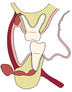 <p>If bone erosion is below buccinator muscle attachment: </p><p>• Maxilla → Vestibular space </p><p>• Mandible → Buccal space</p><p>If bone erosion is above buccinator muscle attachment: </p><p>• Maxilla → Buccal space </p><p>• Mandible → Vestibular space</p>