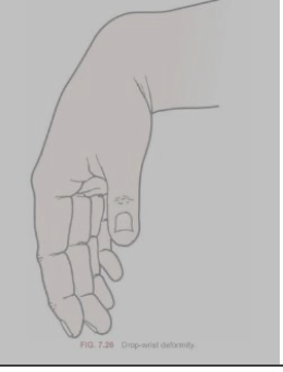 <p>Drop Wrist Deformity</p>