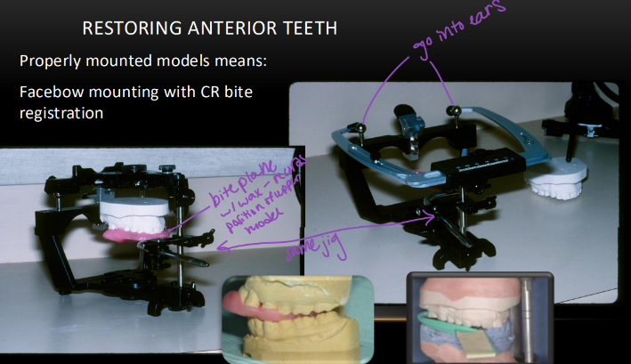 <p>-facebow mounting with CR bite registration</p>