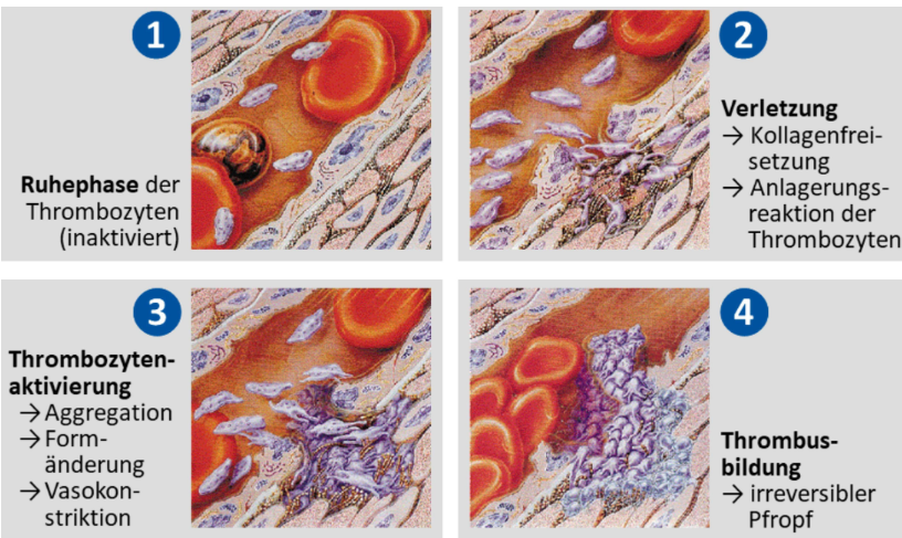 <p><strong>Mechanismus der primären Hämostase</strong><br><span>Pseudo-Endothel-Funktion der Plättchen (Endothel = innere Zellschicht der Blutgefäße)</span><br></p><ol><li><p>Ruhephase der Thrombozyten (keine Aktivierung)</p></li><li><p>Bei einer Verletzung werden Gewebeteile freigesetzt, u.a. auch Kollagen, worauf die Thrombozyten reagieren können --> sie werden aktiviert</p></li><li><p>Aktivierte Thrombozyten bilden Pseudopodien („Scheinfüßchen“) aus und können so mechanisch aneinander haften</p></li><li><p>Viele verhaftete Thrombozyten bilden den Thrombozytenpfropf oder Thrombus</p></li></ol><p></p>