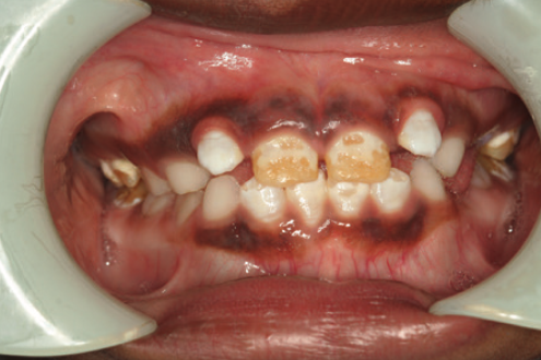 <p><span style="color: red;">hypomineralization of enamel</span> due to excessive exposure to fluoride during enamel mineralization</p><ul><li><p>severity ranges from:</p><ul><li><p>mild, moderate, severe</p></li></ul></li><li><p>degree of hypomineralization <span style="color: red;">depends</span> <span style="color: red;">on the fluoride concentration</span> in the serum during amelogenesis</p></li><li><p>individual susceptibility varies due to:</p><ul><li><p><span style="color: red;">genetic makeup</span></p></li><li><p><span style="color: red;">overall health status</span></p></li><li><p>multiple genes contribute to differences in fluorosis susceptibility</p></li></ul></li><li><p>mechanism:</p><ul><li><p>fluoride contributes to fluorosis by affecting:</p><ul><li><p>ameloblasts</p></li><li><p>developing enamel matrix</p></li><li><p>processing (maturation) of the enamel matrix</p></li></ul></li></ul></li></ul><p></p><p></p>