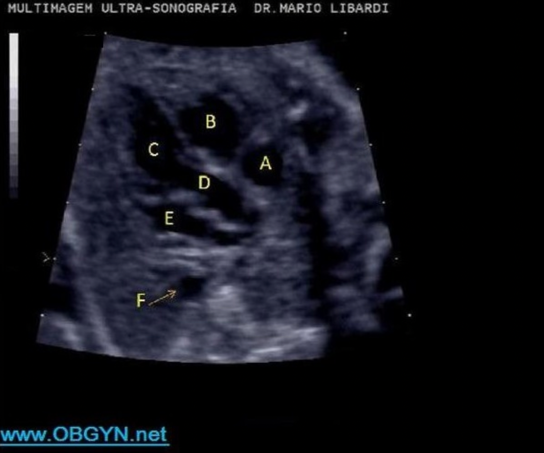<p>Letter A indicates which cardiac structure?</p><p>A. right ventricle</p><p class="p1">B. RVOT</p><p class="p1">C. left atrium</p><p class="p1">D. LVOT</p><p class="p1">D. right atrium</p>