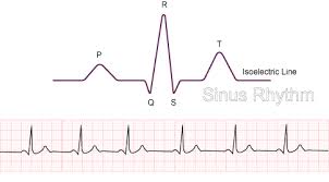 <p>normal sinus rhythm</p>