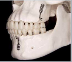 <p>what appliance for class III treatment:</p><p>◦ Intraoral plates screwed into the bone with protruding hooks</p><p>◦ Plates and screws are inserted under general anesthesia</p><p>◦ Require raising a flap</p><p>◦ Class III elastics are worn from the hooks</p><p>◦ These bone anchored elastics apply a protraction force to the maxilla, encouraging forward growth of the maxilla</p><p>◦ Works better in adolescents than facemask alone</p>