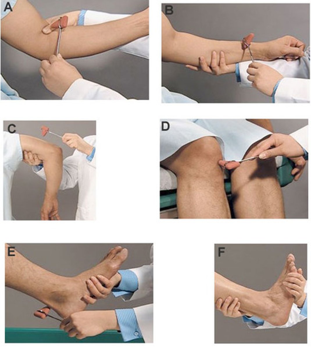 <p>involuntary muscle contraction in response to striking muscle tendon with reflex hammer</p>