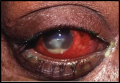 <p>Painful red eye, may have reduced visual acuity, eyelid swelling and photophobia.</p><p>Corneal defects can be seen with fluorescein staining</p><p>Hypopyon</p>