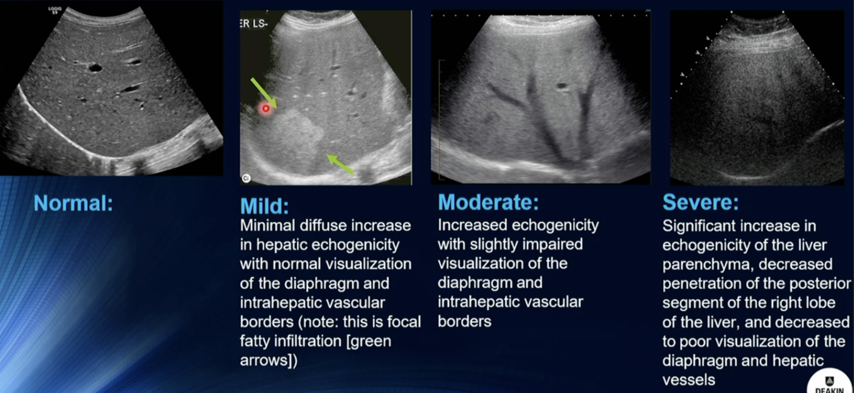 <p>Fatty Infiltration</p>