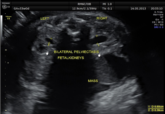 <ul><li><p>dilated anechoic renal pelvis</p></li><li><p>measurement criteria:</p><ul><li><p>measure renal pelvis in AP (TRV image, spine anterior)</p></li><li><p><span style="color: red;"><7mm=mild hydro</span></p></li><li><p><span style="color: red;">7-10mm=moderate hydro</span></p></li><li><p><span style="color: red;">>15mm=severe hydro</span></p></li></ul></li></ul><p>**sweep up and down in TRV to prove its kidney</p>
