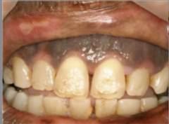 <p>How would you describe the physiologic pigmentation in the image?</p>