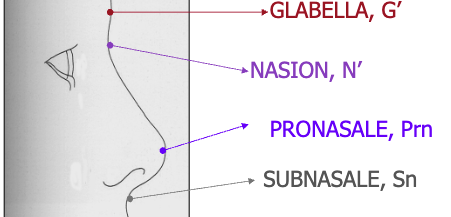 <p>Glabella to subnasale</p>