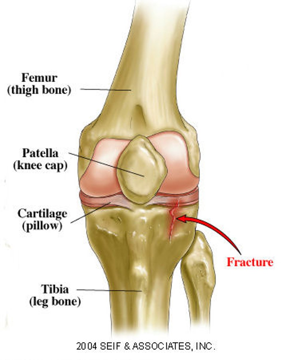 <p>whether fracture reaches articular surface (joint)</p>