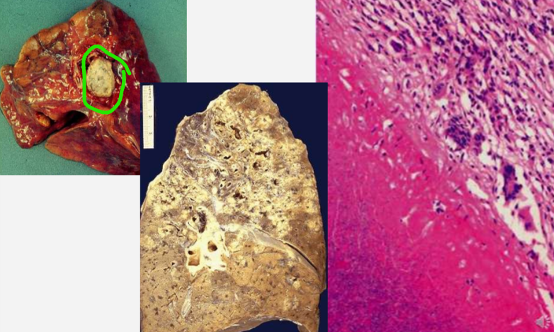 <ul><li><p>gelsvai baltas, sausą varškę primenanti masė</p></li><li><p>trupi</p></li><li><p>aplink uždegimo ląstelės</p></li></ul><p></p>