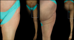 <p>Upper groin and lower back</p><p>Inguinal ligament area</p>
